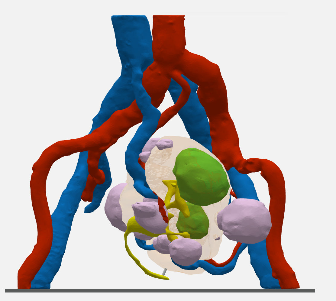 Clear Left Kidney With Neoplasm and Cysts – Male, 78 Years