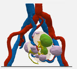 Clear Left Kidney With Neoplasm and Cysts – Male, 78 Years