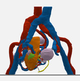 Opaque Left Kidney With Neoplasm and Cysts – Male, 78 Years