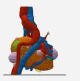 Opaque Left Kidney With Neoplasm and Cysts – Male, 78 Years