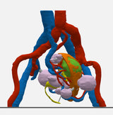 Opaque Left Kidney With Neoplasm and Cysts – Male, 78 Years