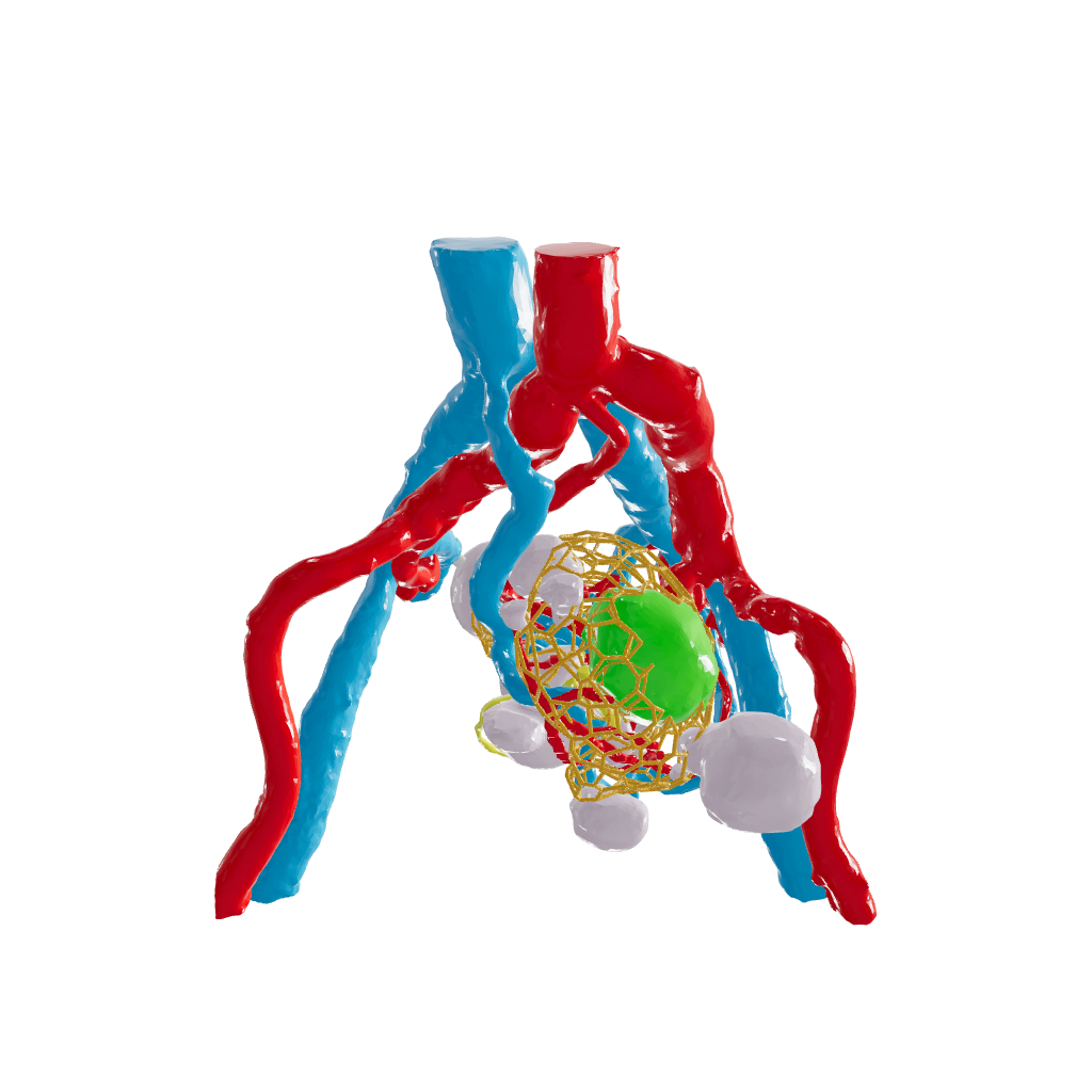 Lattice Left Kidney With Neoplasm and Cysts – Male, 78 Years