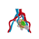 Lattice Left Kidney With Neoplasm and Cysts – Male, 78 Years