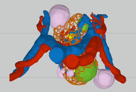 Lattice Left Kidney With Neoplasm and Cysts – Male, 78 Years