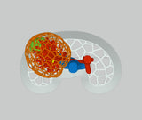 Lattice Right Kidney With Wilms Tumor (Nephroblastoma) - Male, 3 Years