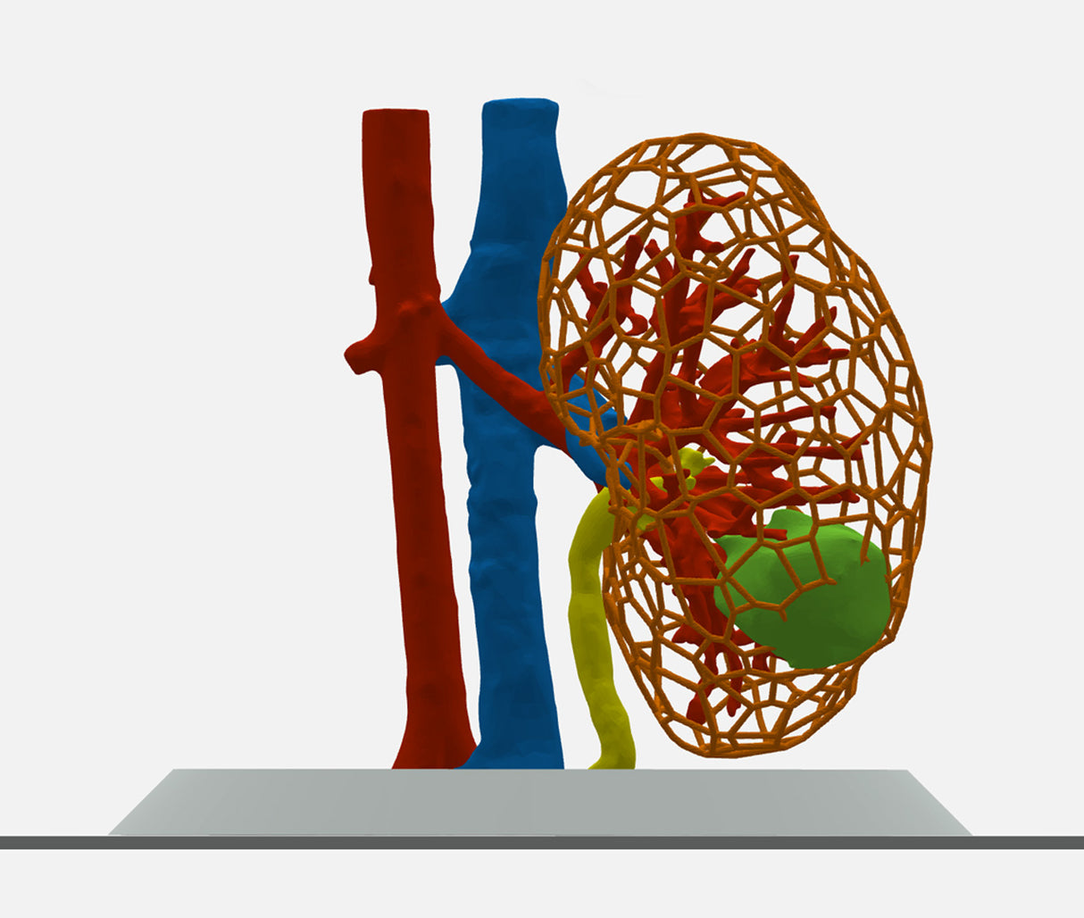 Lattice Right Kidney With Wilms Tumor (Nephroblastoma) - Male, 3 Years