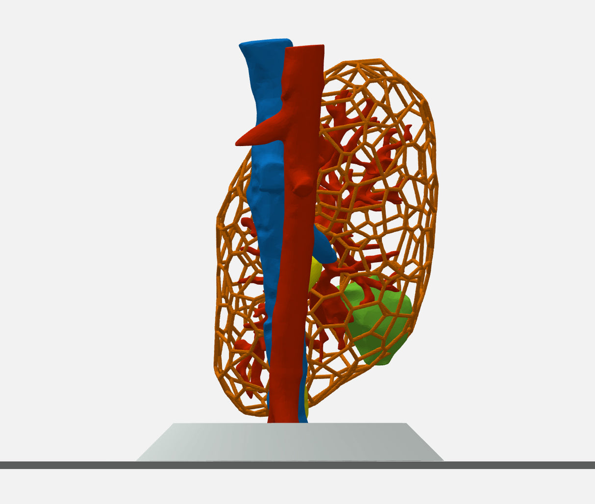 Lattice Right Kidney With Wilms Tumor (Nephroblastoma) - Male, 3 Years