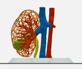 Lattice Right Kidney With Wilms Tumor (Nephroblastoma) - Male, 3 Years