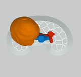 Solid Opaque Right Kidney With Wilms Tumor (Nephroblastoma) - Male, 3 Years