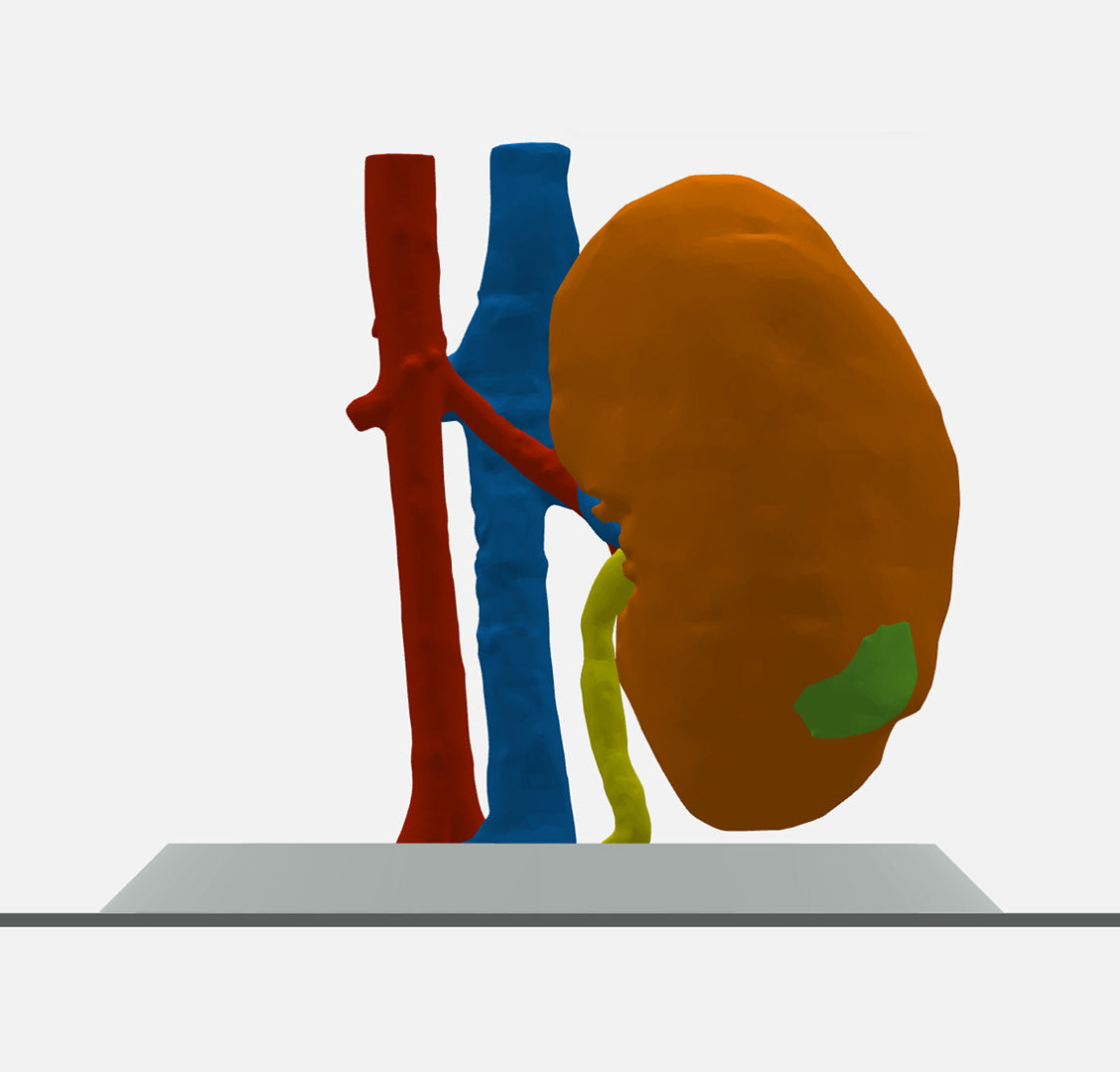 Solid Opaque Right Kidney With Wilms Tumor (Nephroblastoma) - Male, 3 Years