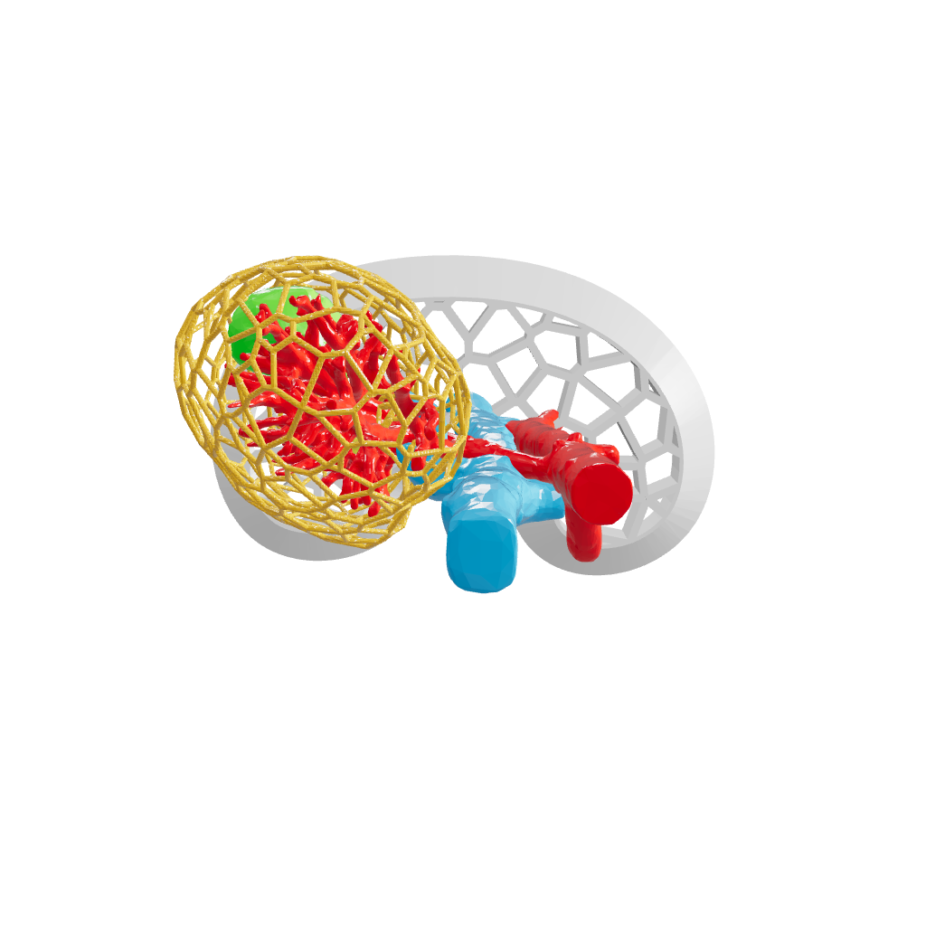 Lattice Right Kidney With Wilms Tumor (Nephroblastoma) - Male, 3 Years