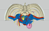 Chest With Mediastinal Paraganglioma – Male, 50 Years