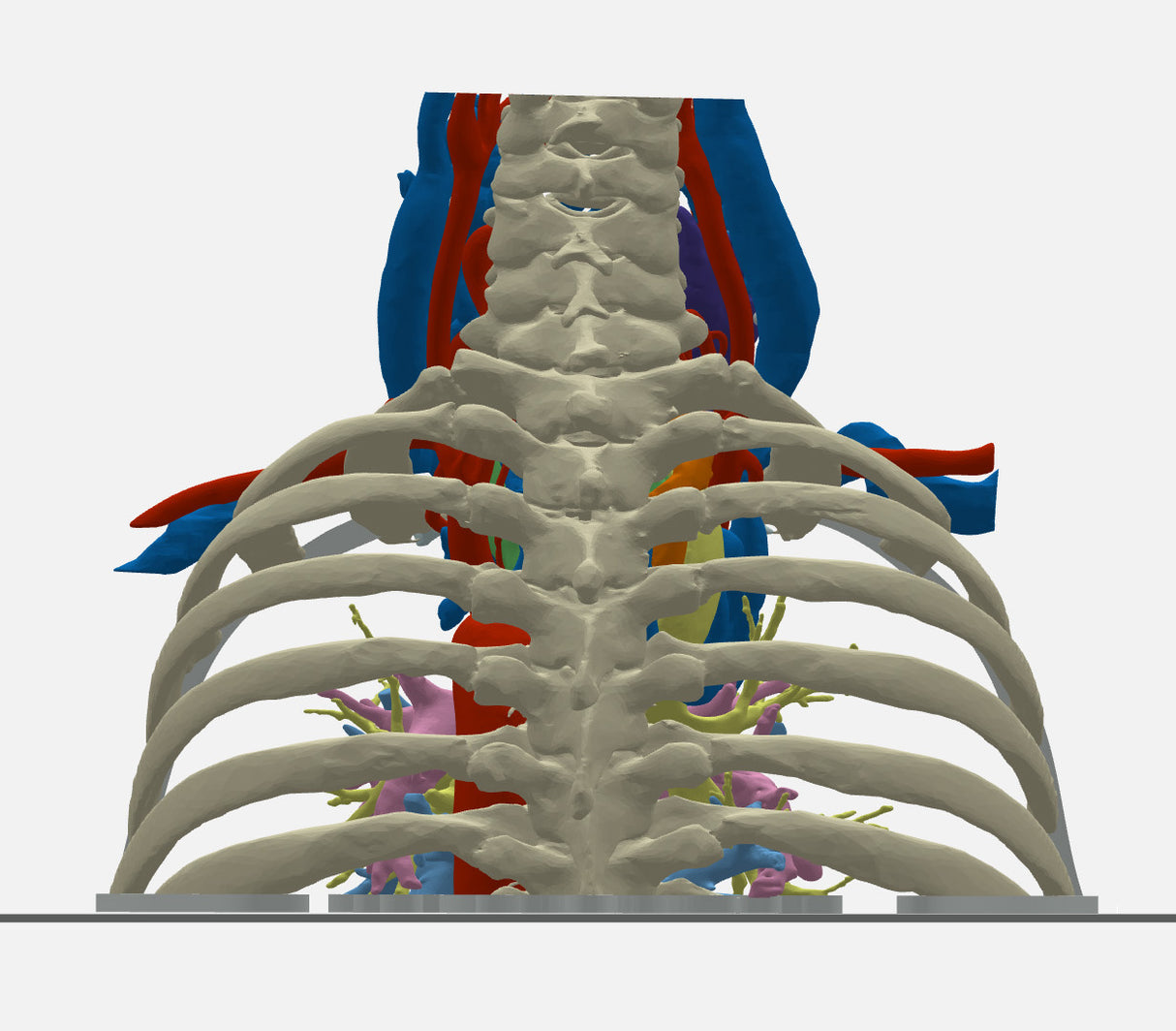 Chest With Mediastinal Paraganglioma – Male, 50 Years