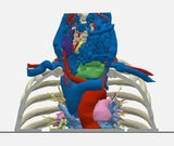 Chest With Mediastinal Paraganglioma – Male, 50 Years