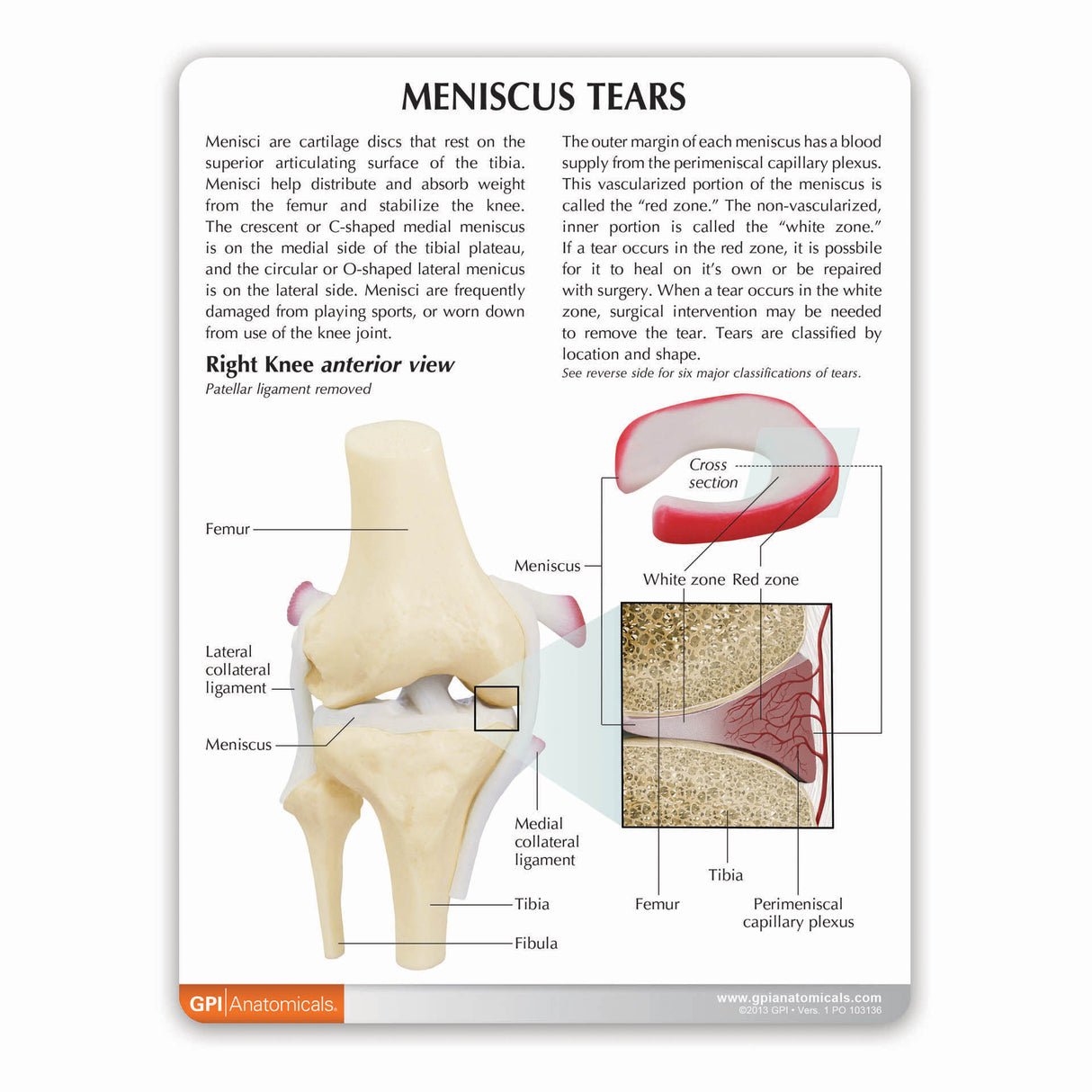 Knee Model with Meniscus Tears