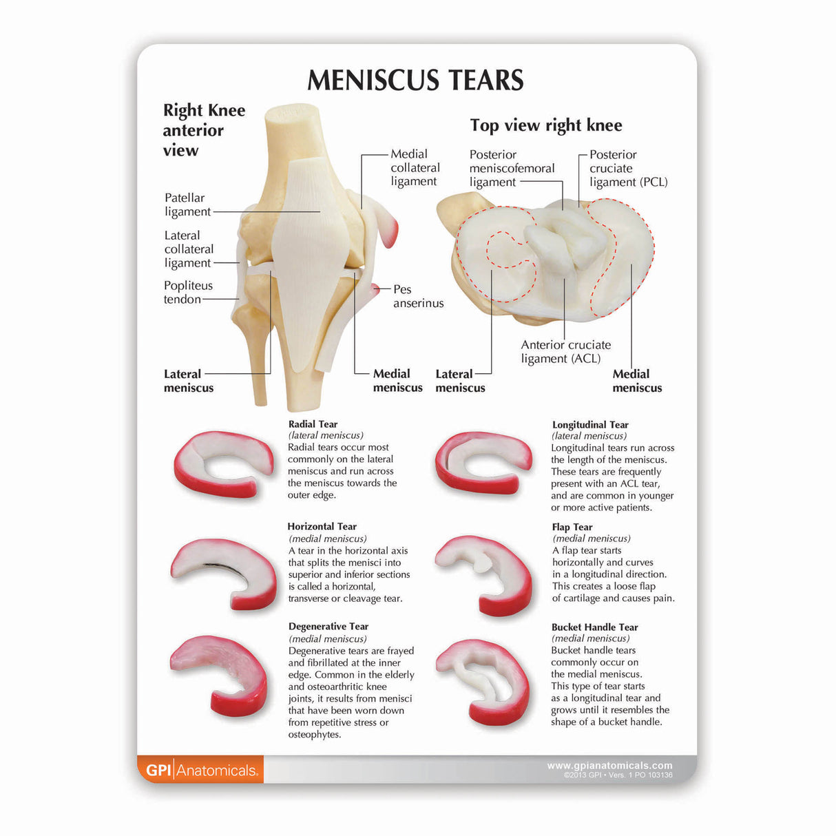 Knee Model with Meniscus Tears