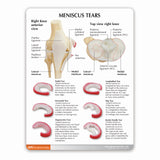 Knee Model with Meniscus Tears