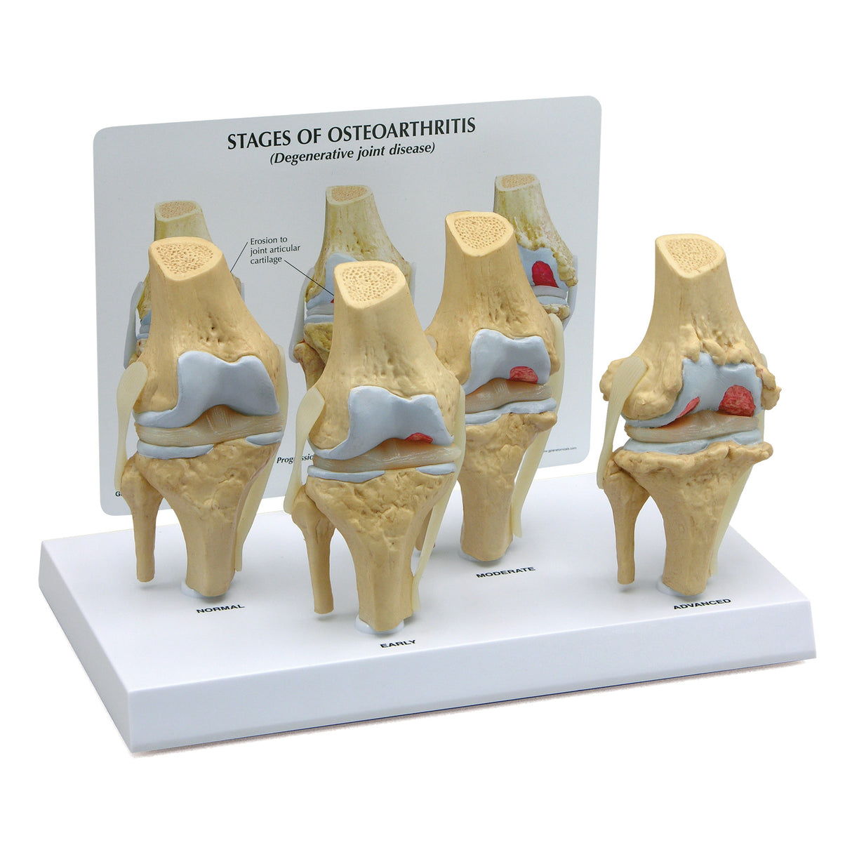 4-Stage Osteoarthritic Knee