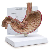 Stomach Cancer Model