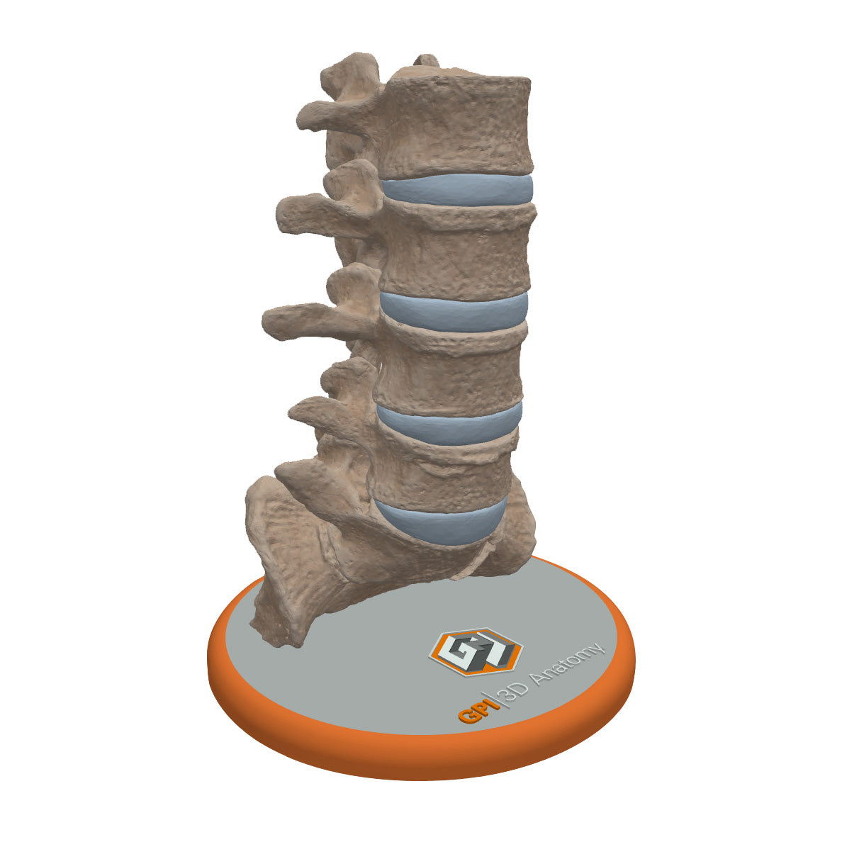 Spine With Bilateral Spondylolysis (Pars Defect), Grade 2 – Male, 27 years