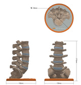 Spine With Bilateral Spondylolysis (Pars Defect), Grade 2 – Male, 27 years