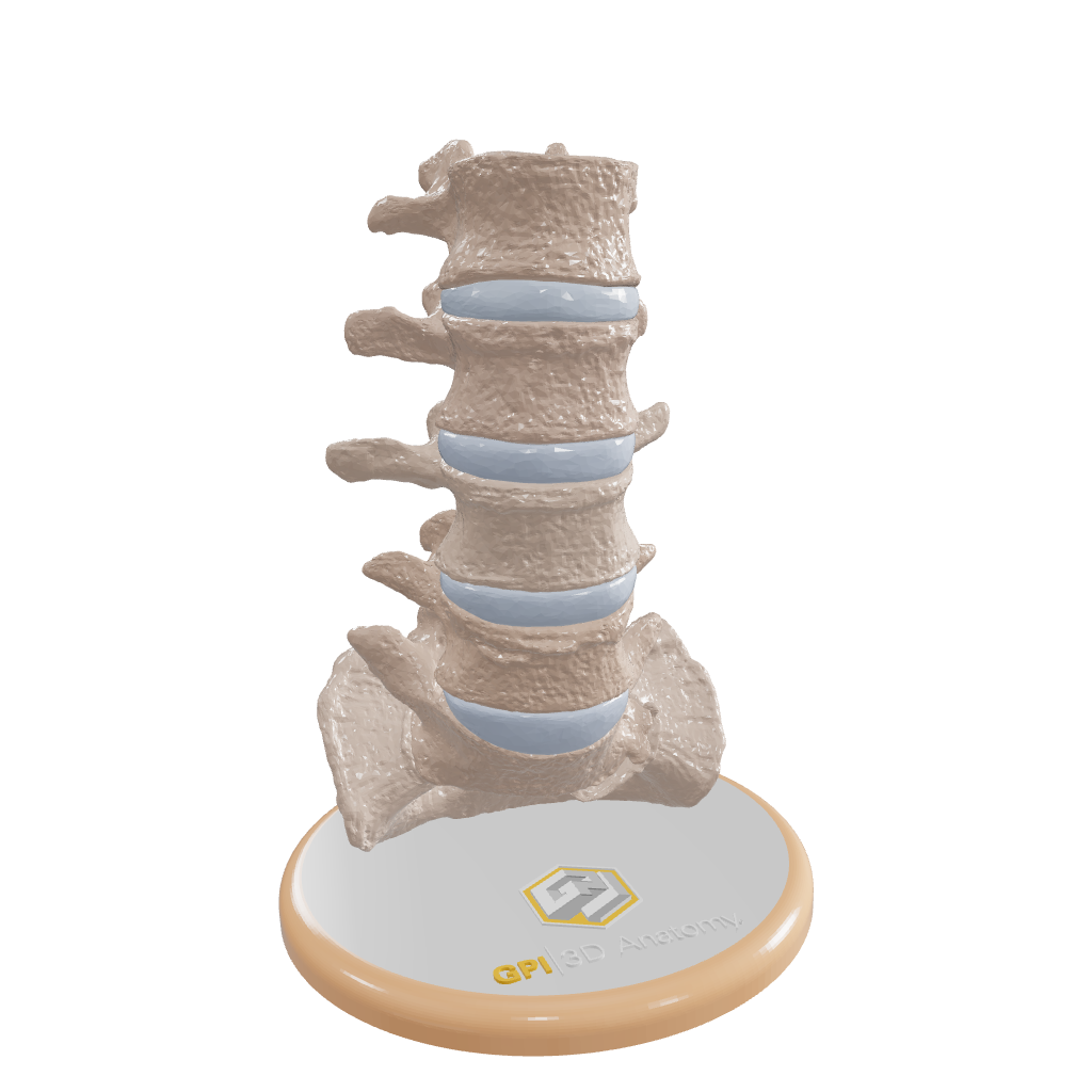 Spine With Bilateral Spondylolysis (Pars Defect), Grade 2 – Male, 27 years