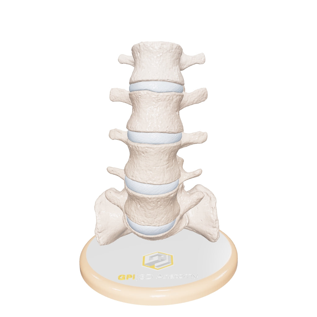 Spine With Spondylolisthesis (Anterolisthesis), Grade 3 – Female, 17 Years