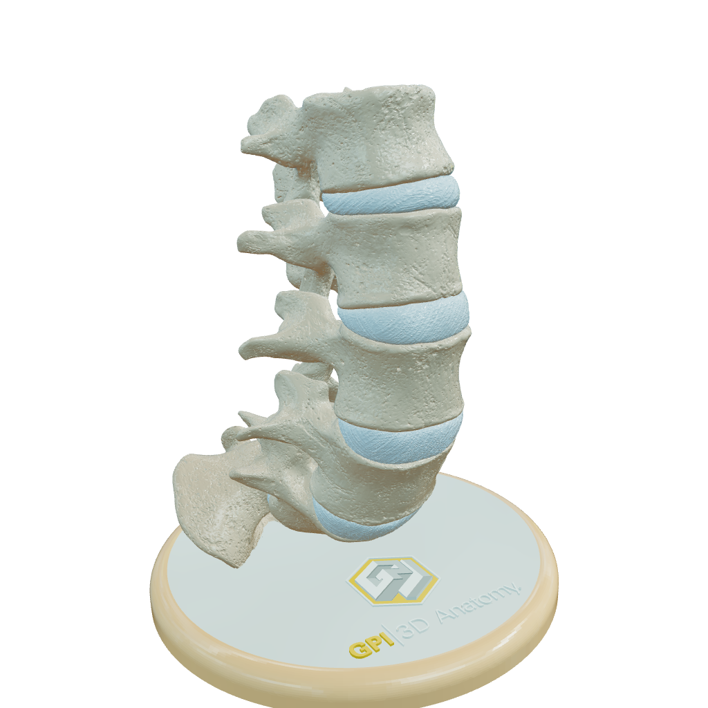 Spine With Spondylolisthesis (Anterolisthesis), Grade 5