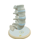 Spine With Spondylolisthesis (Anterolisthesis), Grade 5